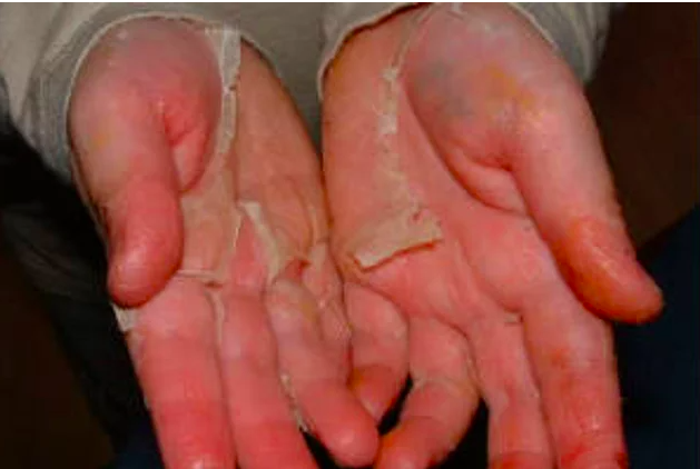 Kawasaki sendromu hastalığı belirtileri neler ateşe dikkat! - Resim: 0