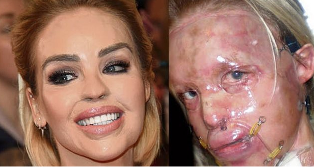 Eski sevgilisi tecavüz edip yüzüne asit fırlattı! Kadın bambaşka biri oldu - Resim: 3