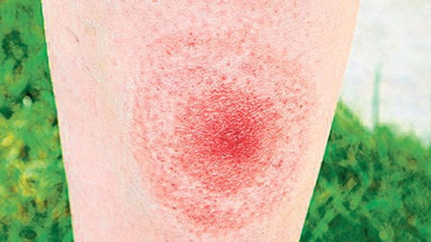 Bu virüs 365 hastalığı taklit edebiliyor! - Resim: 2