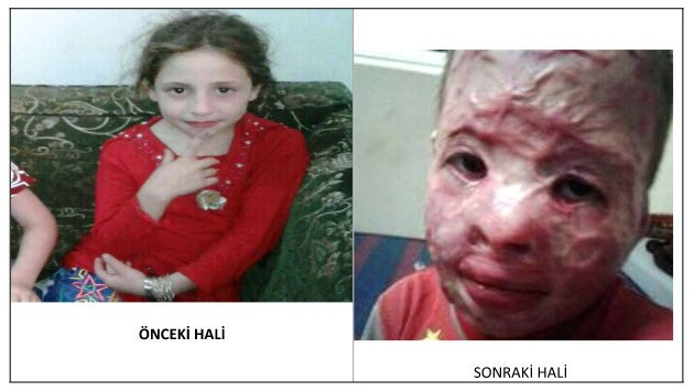 Suriyeli kız çocuğu böyleydi bu hale geldi - Resim: 2