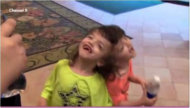 Kafadan yapışık ikizler herkesi şaşırtıyor - Resim: 4