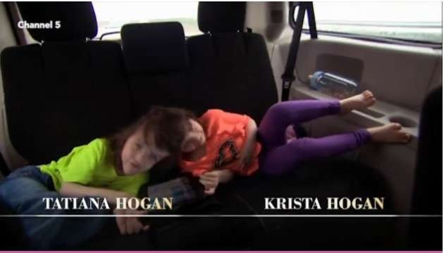 Kafadan yapışık ikizler herkesi şaşırtıyor - Resim: 3