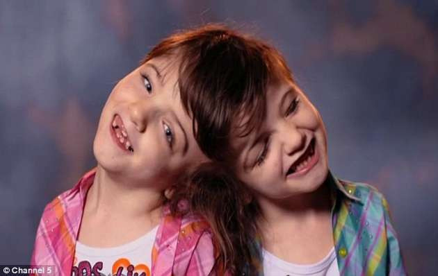 Kafadan yapışık ikizler herkesi şaşırtıyor - Resim: 1