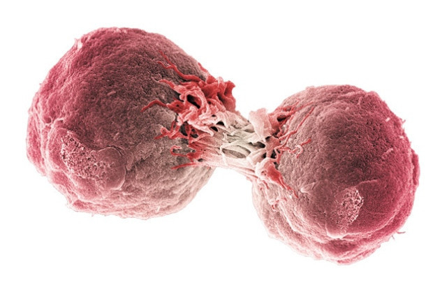 Lösemi nasıl anlaşılır profesör açıkladı kan kanserinin 10 önemli belirtisi  - Resim: 1