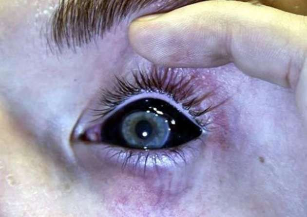 Gözlerine dövme yaptıran çılgınlar - Resim: 3