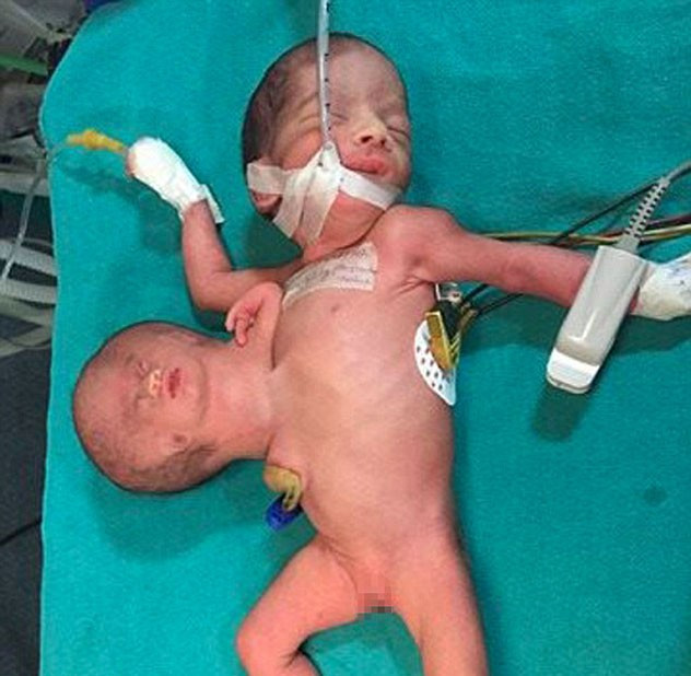 Yenidoğan bebeğin karnından çıkan doktorları şoke etti! - Resim: 2