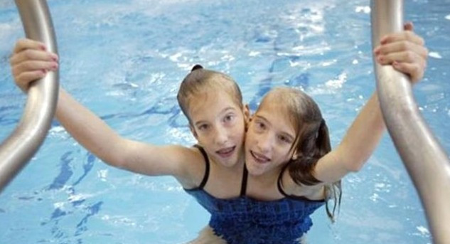 Tek vücutta iki kişi yaşıyorlar! Son halleri... - Resim: 3