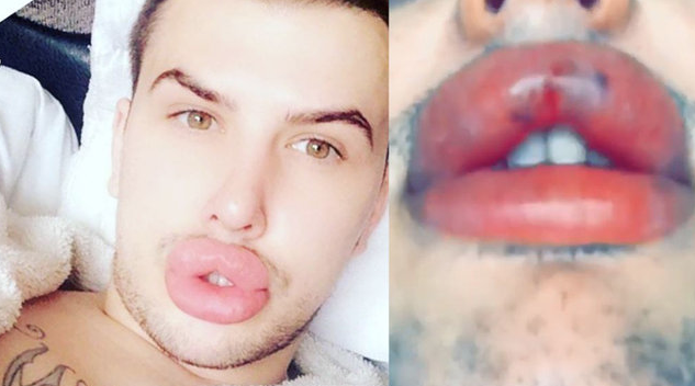 Görenler şaşıp kaldı! Dudakları patlama noktasına geldi - Resim: 1