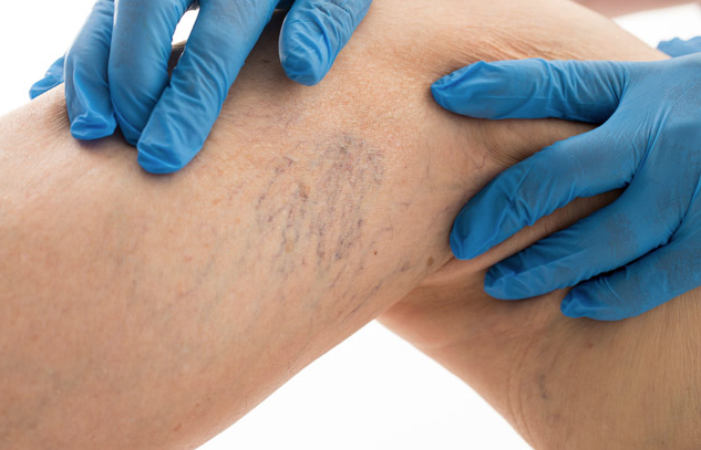 Bacak bacak üstüne atarak oturmayın! Varis tehlikesi... - Resim: 2