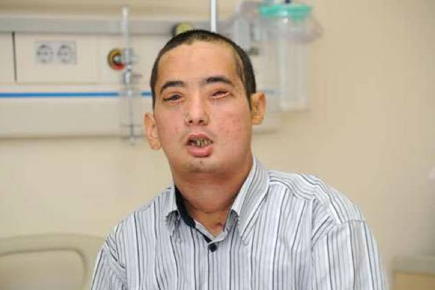 İşte 2. tam yüz nakli yapılan genç  - Resim: 3