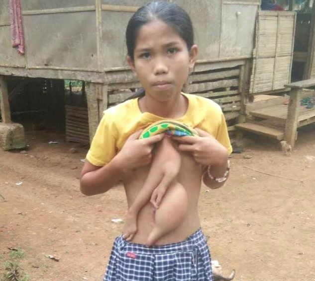 Vücudunda bir vücutla daha doğdu korkup kaçıyorlar! - Resim: 2