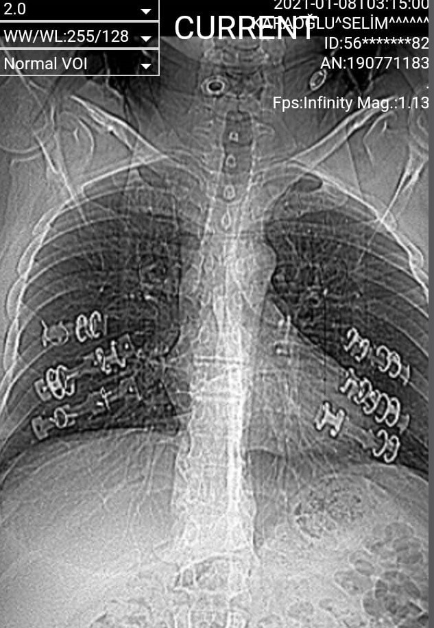 Öksürük şikayetiyle hastaneye gitti hayatının kabusunu yaşadı - Resim: 1