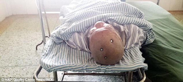 Kafasına çakılan 3 çivi ile hastaneye gitti! - Resim: 1