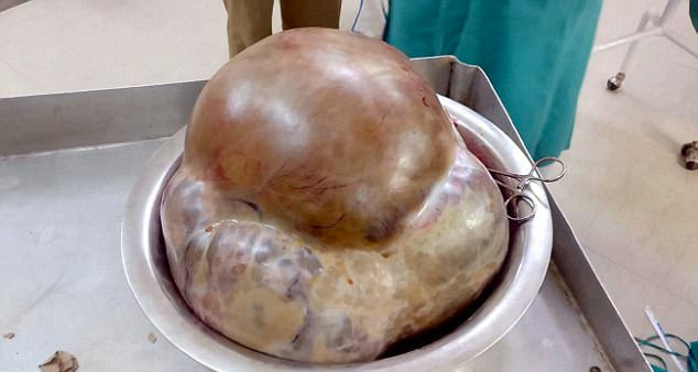 Herkes onu hamile sandı ama karnından öyle bir şey çıktı ki - Resim: 2