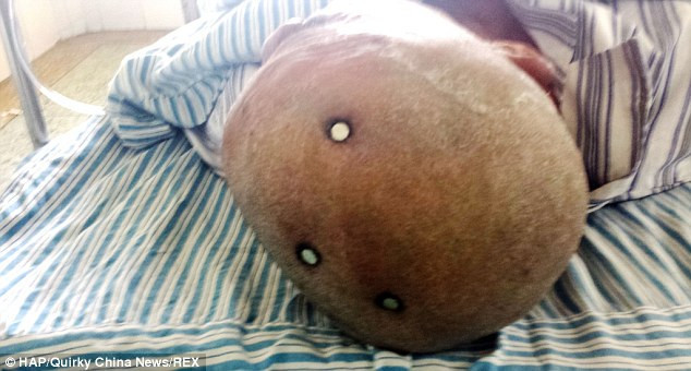 Kafasına çakılan 3 çivi ile hastaneye gitti! - Resim: 2