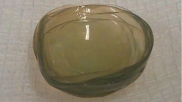 Gözünde 27 lens kayboldu 35 yıl fark etmedi! - Resim: 3