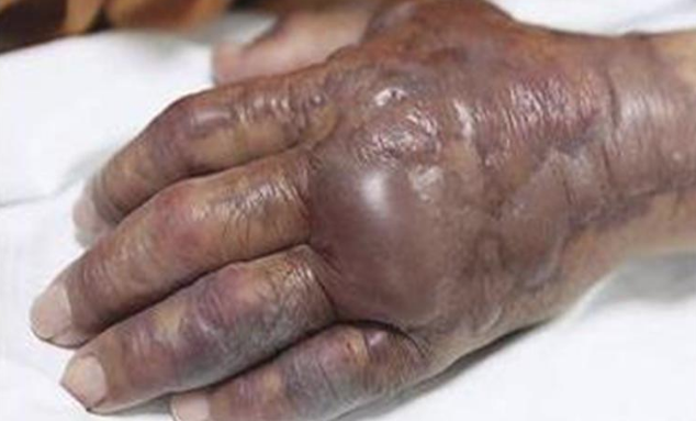 Yediği şey yüzünden eli bu hale geldi ardından kesildi - Resim: 2