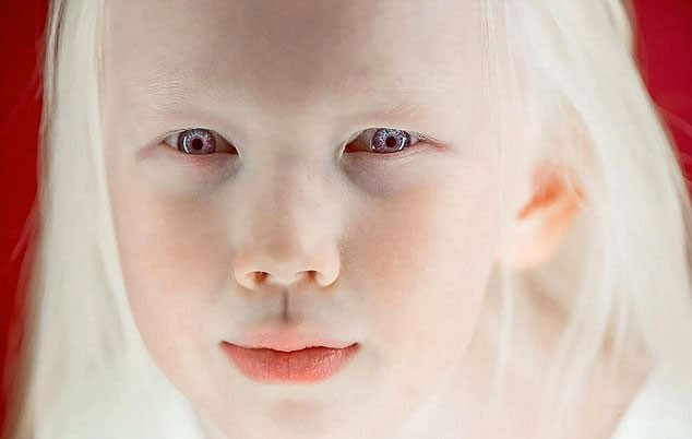 Görenleri hayrete düşüren kız gerçek 'pamuk prenses' - Resim: 3