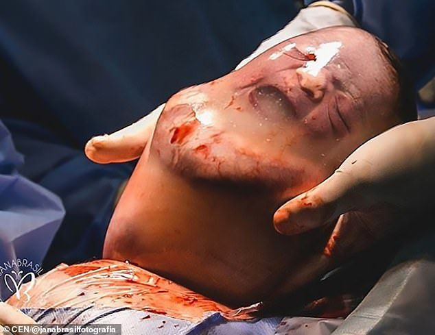 100 bin vakada bir görülen olay! Doğum mucizesi amniyotik kese nedir? - Resim: 4