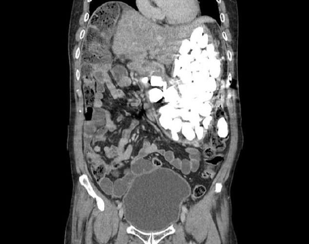 Midesinden çıkanı duyunca şoke olacaksınız! Tam 2 kilo - Resim: 1