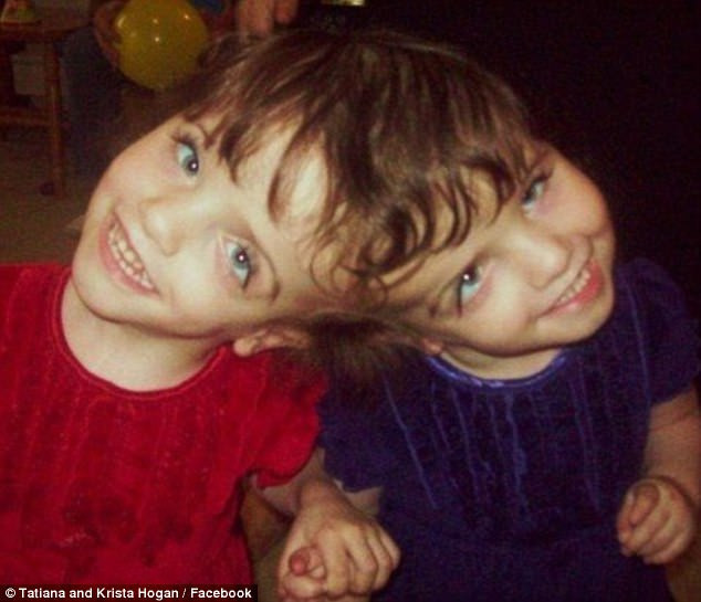 Kafadan yapışık ikizler 10 yaşına girdi! - Resim: 3