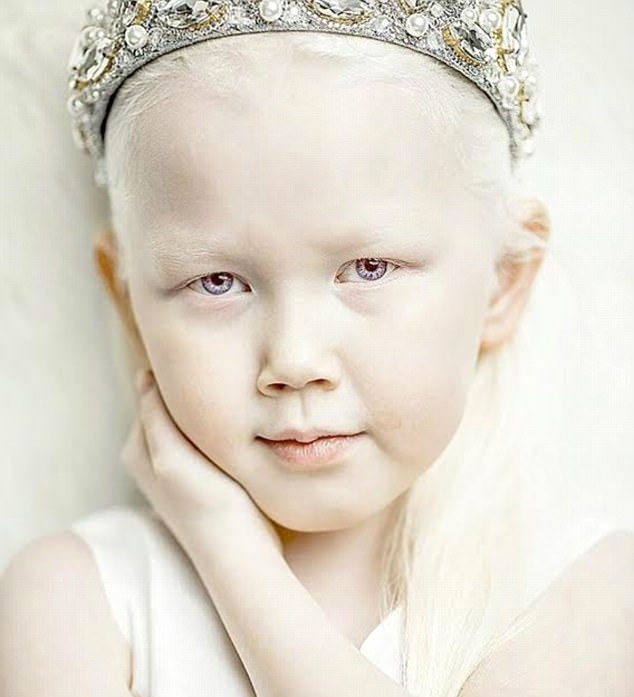 Görenleri hayrete düşüren kız gerçek 'pamuk prenses' - Resim: 2