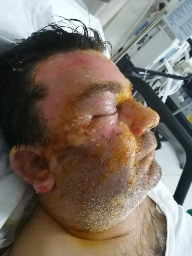 Sakarya'da dehşeti yaşadı! Can havliyle uykusundan uyandı yüzü tanınmaz hale geldi - Resim: 0