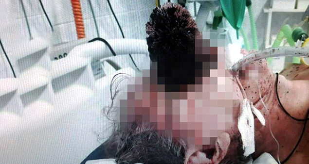 Tuvalet fırçası gözüne saplandı akıllara durgunluk veren olay! - Resim: 2