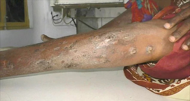 Doktorlar şaşkın iğne yumurtlayan kadından 70 tane iğne çıktı - Resim: 2