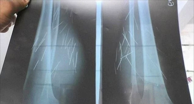 Doktorlar şaşkın iğne yumurtlayan kadından 70 tane iğne çıktı - Resim: 3