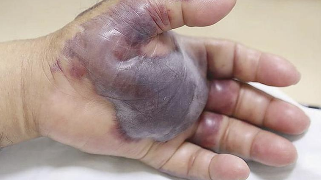 Yediği şey yüzünden eli bu hale geldi ardından kesildi - Resim: 1