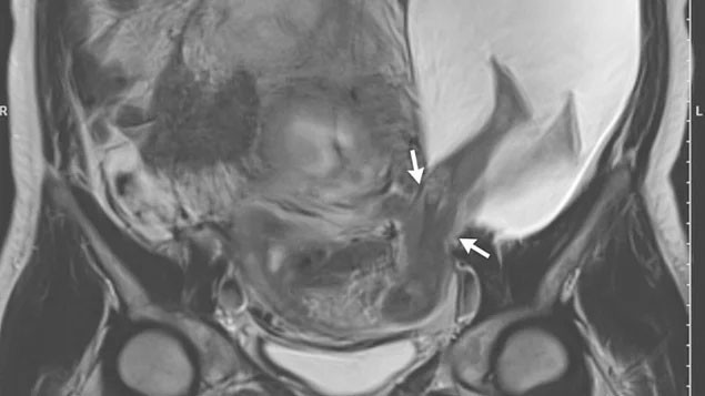 Anne karnındaki bebek tekmeleriyle rahim duvarını yırttı! - Resim: 1