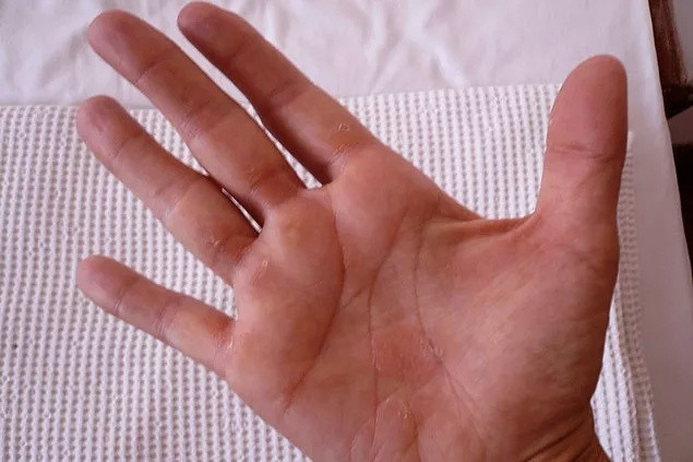 Avucunuzu açın ve dikkatli bakın! Kızarıklık varsa hiç durmayın hemen doktora gidin! - Resim: 1