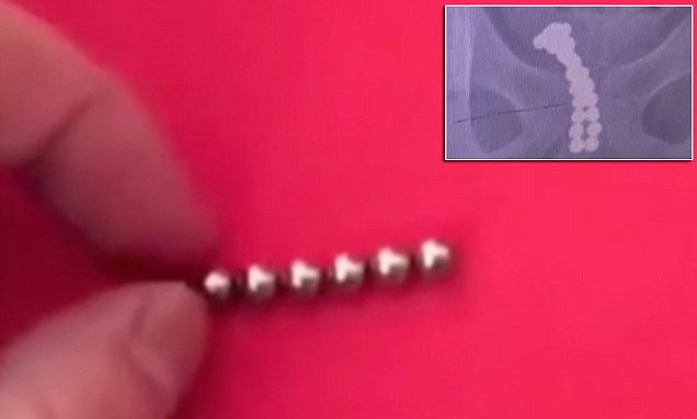 Penisinden çıkan şeyler şok etti! Tam 26 adet bakın nasıl içine girmiş - Resim: 3