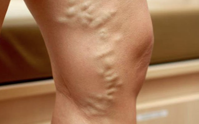 Bacak bacak üstüne atarak oturmayın! Varis tehlikesi... - Resim: 4