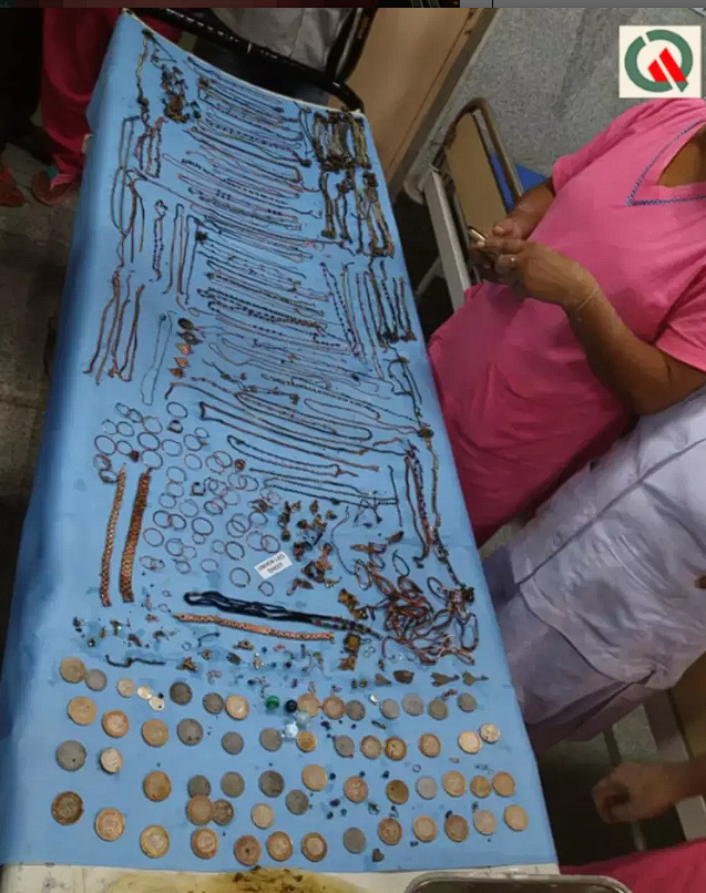 Genç kadının midesi kuyumcu dükkanı gibi! Doktorlar bile şaşkına döndü - Resim: 1