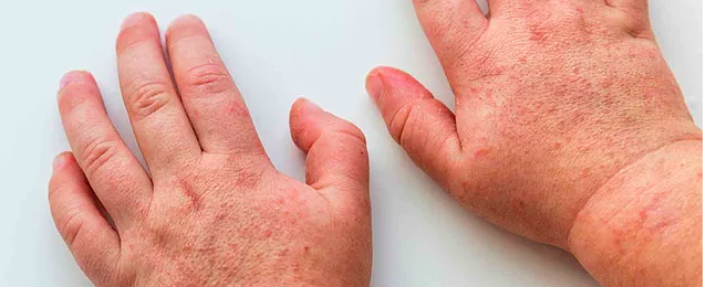 Kawasaki sendromu hastalığı belirtileri neler ateşe dikkat! - Resim: 2