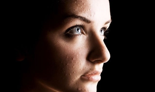 Çenenizde sivilce çıkıyorsa dikkat - Resim: 4