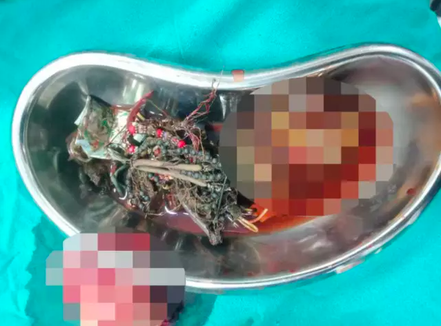 Midesinde çıkanlarla sergi açılır! Öyle şeyler çıktı ki Doktorlar bile şaştı kaldı - Resim: 1