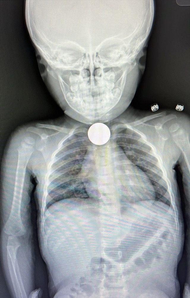 Minik İkra evde oyun oynarken rahatsızlandı, sebebi hastanede ortaya çıktı - Resim: 1