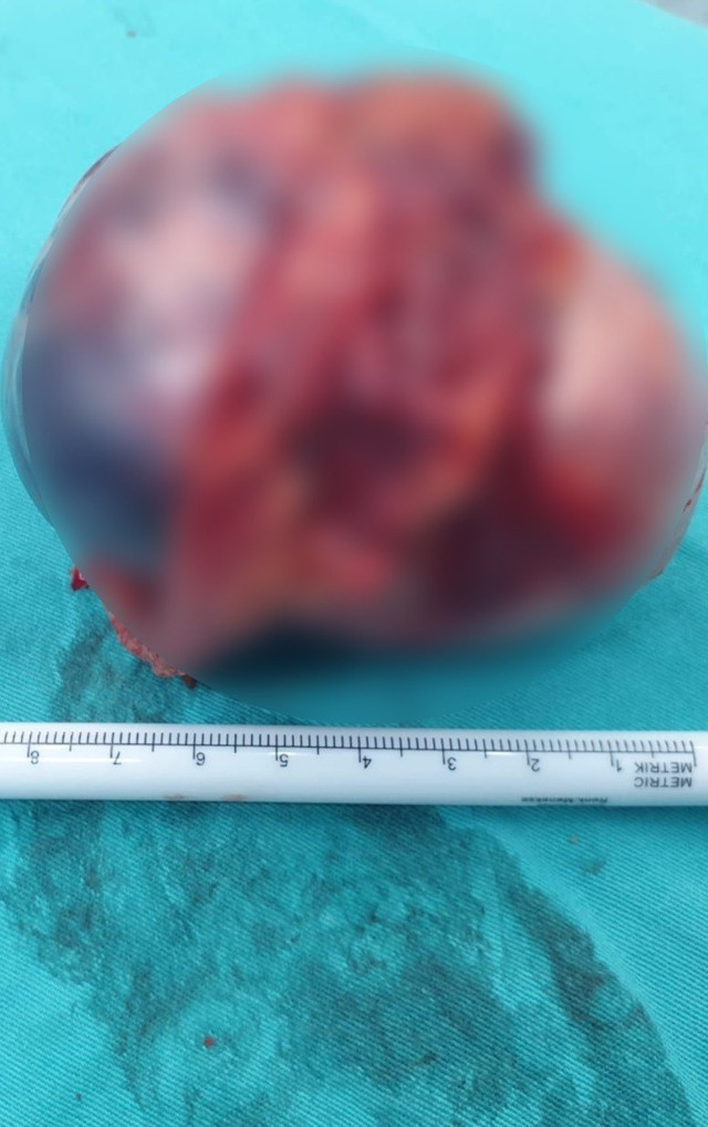 Mide bulantısı şikayetiyle gitti! Bursa'da 14 yaşındaki kızın böbreğinden çıktı - Resim: 0