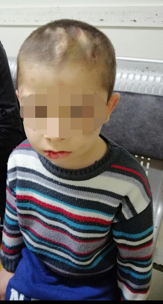 Üvey baba dehşeti! Çocuğa işkence edip üzerinde sigara söndürmüş - Resim: 1