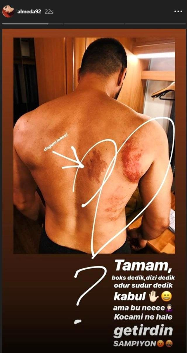Şampiyon'un yıldızı Tolgahan Sayışman'da morlukları gören Almeda Abazi isyan etti - Resim: 3