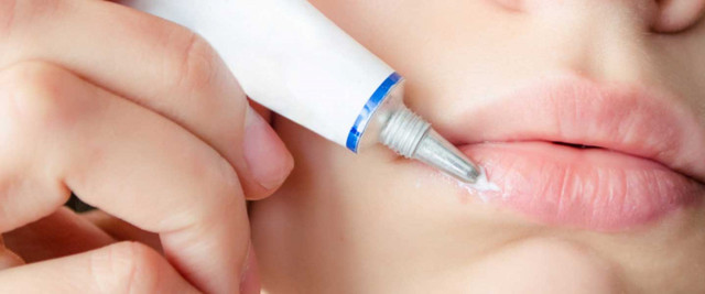 Uçuk neden çıkar uçuk nasıl tedavi edilir evde tedavisi - Resim: 0