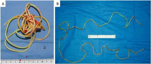 Tam tamına 2 metre! 79 yaşındaki adamın cinsel organından çıkardılar! - Resim: 0