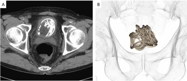 Tam tamına 2 metre! 79 yaşındaki adamın cinsel organından çıkardılar! - Resim: 1