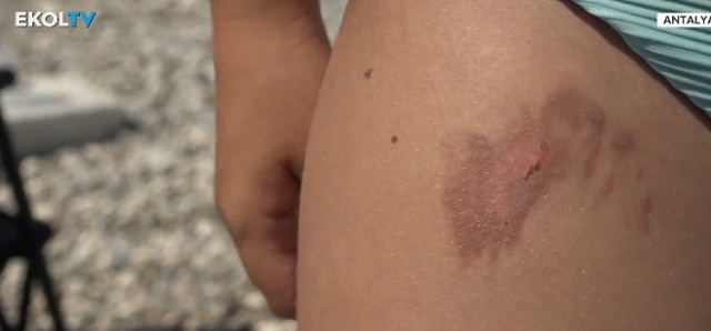 Denize giren korkunç halde çıkıyor! Hastaneler doldu taştı, nedeni belli oldu - Resim: 2