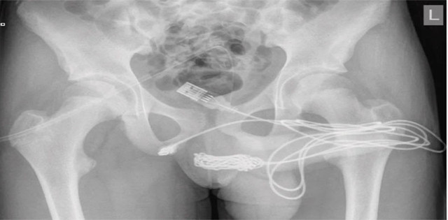 Cinsel organını ölçmek için yaptığı şey herkesi şaşkına uğrattı! Cinsel organına öyle bir şey soktu ki doktorlar bile çaresiz kaldı - Resim: 2