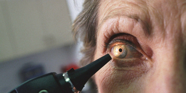 Sarı nokta hastalığı nedir gözü kaybetme riski bulunuyor! - Resim: 0