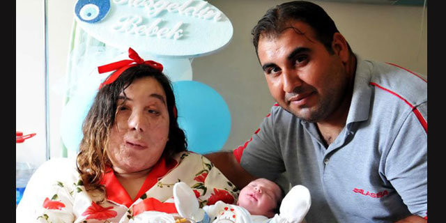 Yüz nakli beklerken bebek sahibi oldu - Resim: 1
